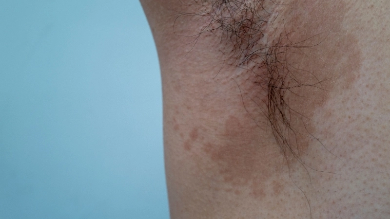 Vị trí và biểu hiện lang ben ở mặt gây mất thẩm mỹ