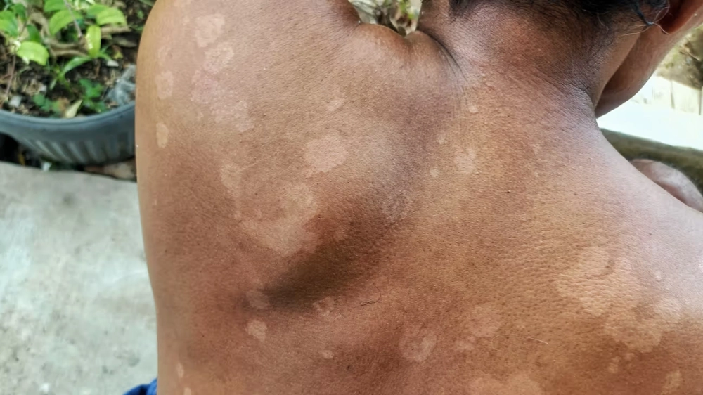 Biểu hiện của lang ben đỏ ở vùng da lưng