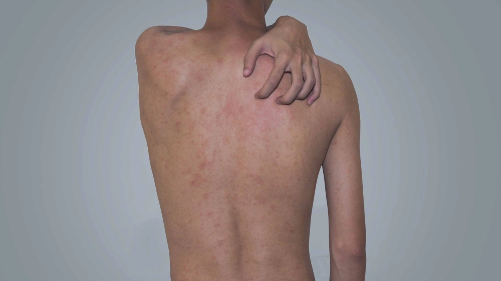 Tổng quan về câu hỏi lang ben đỏ là gì