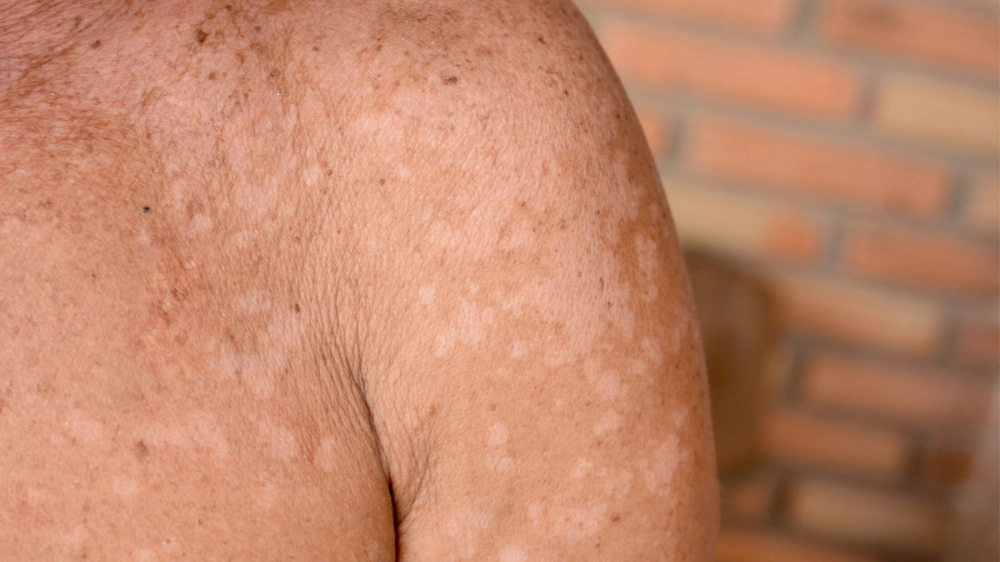 Các loại thuốc bôi lang ben đỏ kháng nấm phổ biến