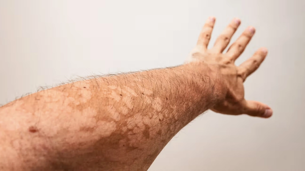 Phân biệt lang ben đỏ và vảy phấn hồng qua hình ảnh