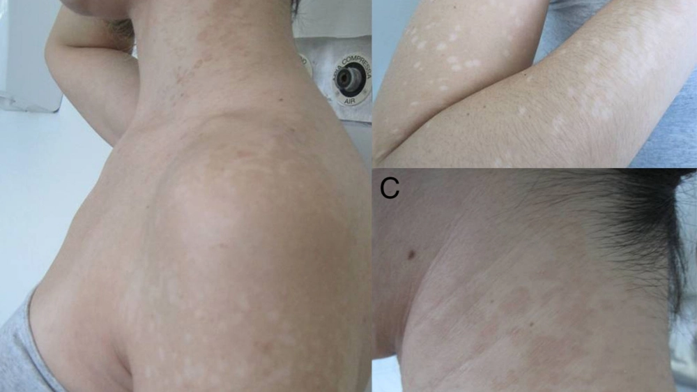 Hình ảnh lang ben trắng, một thể khác của bệnh