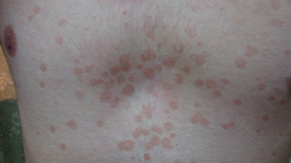 Tìm hiểu các nguyên nhân bị lang ben đỏ thường gặp