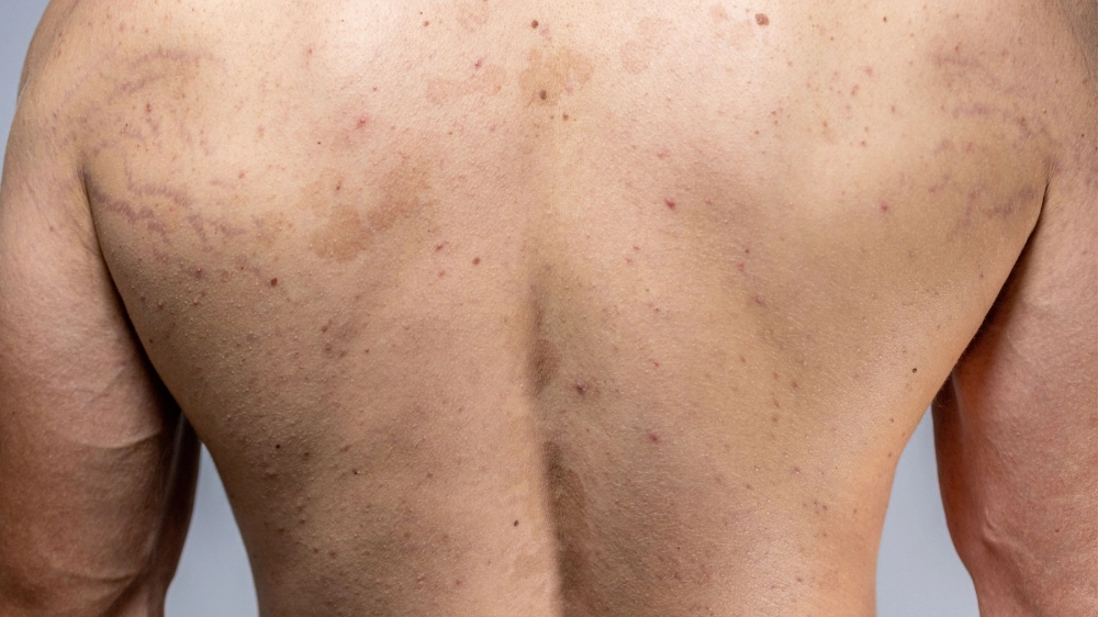 Lang ben đỏ là gì và biểu hiện trên da với các dát hồng ban có vảy mịn