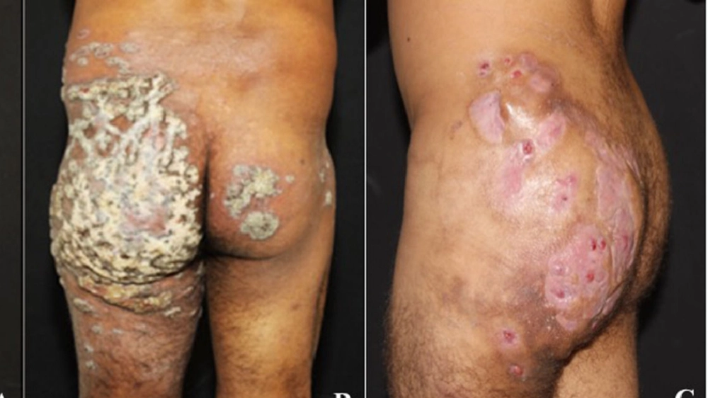 Phác đồ và cách điều trị bệnh lao da hiện nay