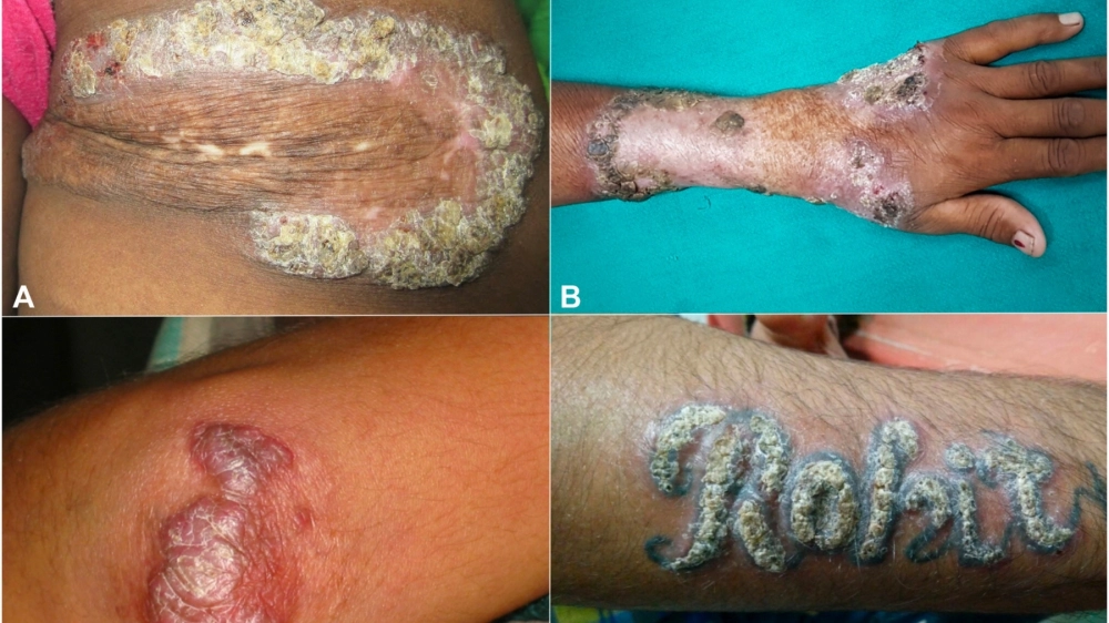 Bệnh lao da có nguy hiểm không nếu không được điều trị