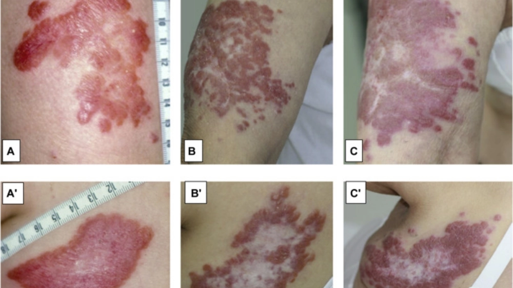 So sánh triệu chứng bệnh lao da thể Lupus Vulgaris và Scrofuloderma