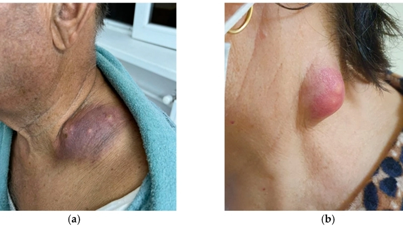 Giải đáp thắc mắc lao hạch có lây không so với lao phổi