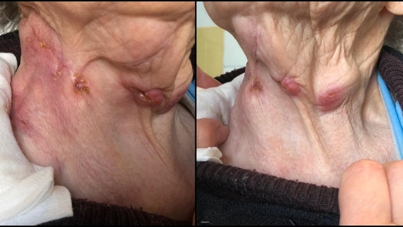 Các dấu hiệu bệnh lao hạch cần đi khám ngay