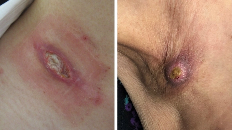 Tìm hiểu các cách điều trị lao hạch bằng thuốc kháng lao