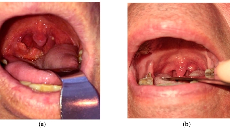 Trường hợp cần can thiệp mổ lao hạch để dẫn lưu mủ