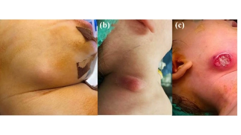 Biểu hiện lâm sàng của lao hạch ở cổ