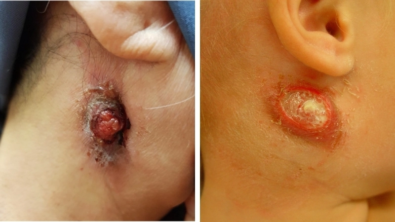 Các phương pháp xét nghiệm lao hạch chẩn đoán chính xác