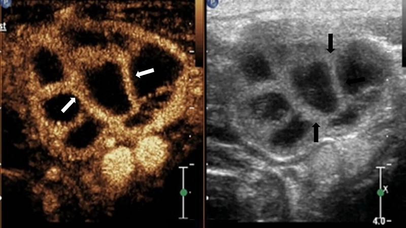 Hình ảnh siêu âm giúp phát hiện các hạch lao