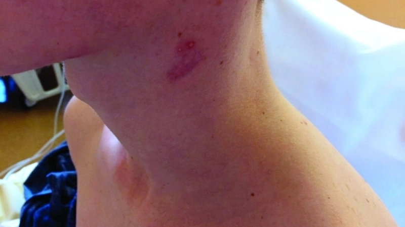 Sẹo điển hình sau khi hạch lao vỡ hoặc phẫu thuật