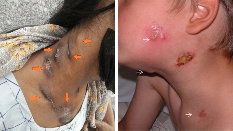 Hình ảnh lao hạch ở cổ, vị trí phổ biến nhất của bệnh với các hạch sưng thành chuỗi