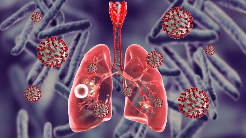 Hình ảnh x quang lao phổi điển hình