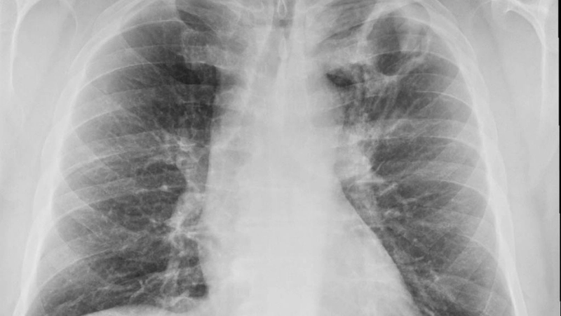 So sánh lao và hình ảnh phổi bình thường