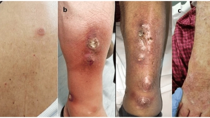 Hình ảnh lao phổi trên CT scan chi tiết