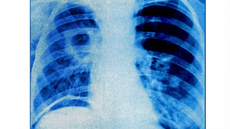 Hình ảnh về bệnh lao thể hiện qua tổn thương đỉnh phổi