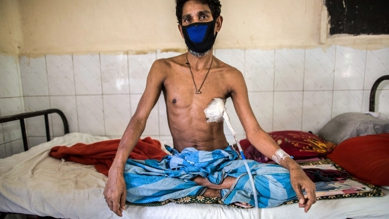 Đặc điểm hình ảnh bệnh lao kê lan tỏa