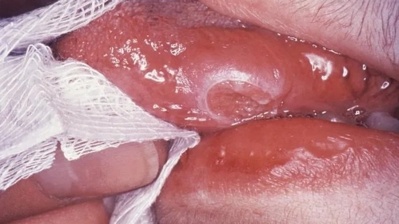 Hình ảnh phổi của người bị lao ở giai đoạn đầu