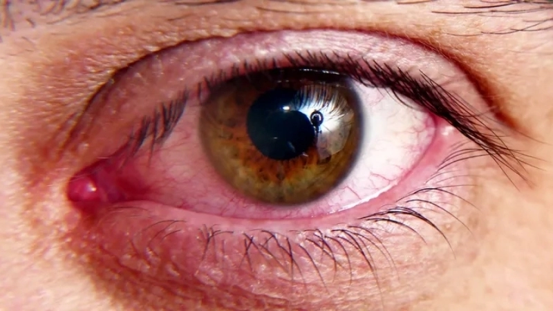 Tổng quan các hình ảnh bệnh lao phổi thường gặp