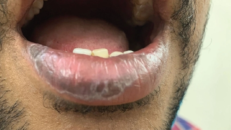 Hiệu quả của thuốc bôi lichen phẳng giảm ngứa và viêm