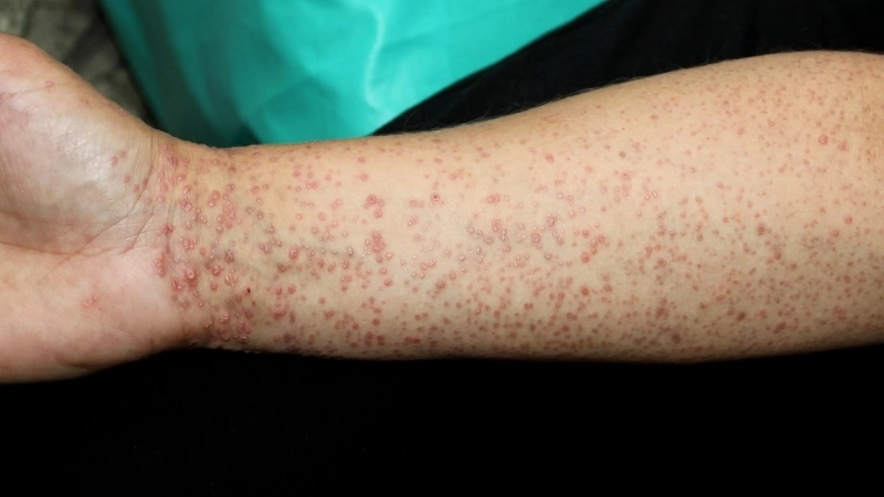 Nhận diện hình ảnh bệnh lichen móng gây biến dạng móng
