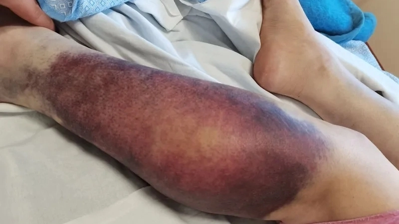 Quy trình thực hiện xét nghiệm Hemophilia