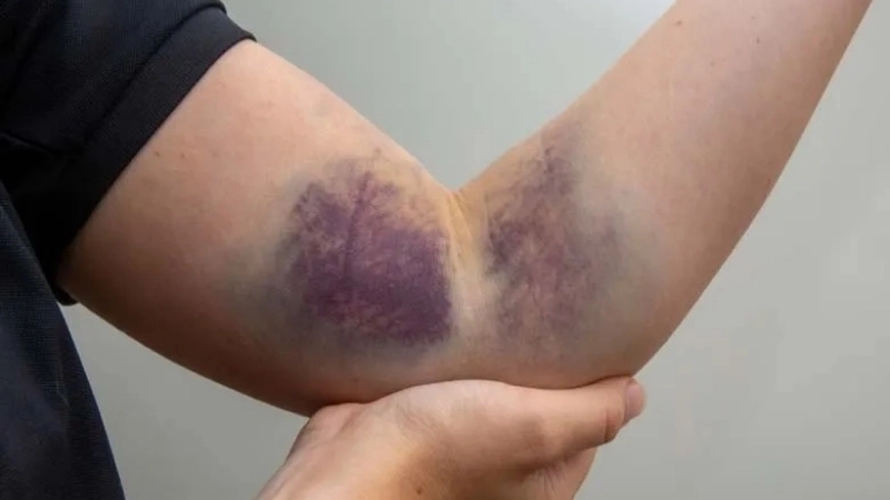 Hình ảnh tụ máu khớp gối do bệnh Hemophilia