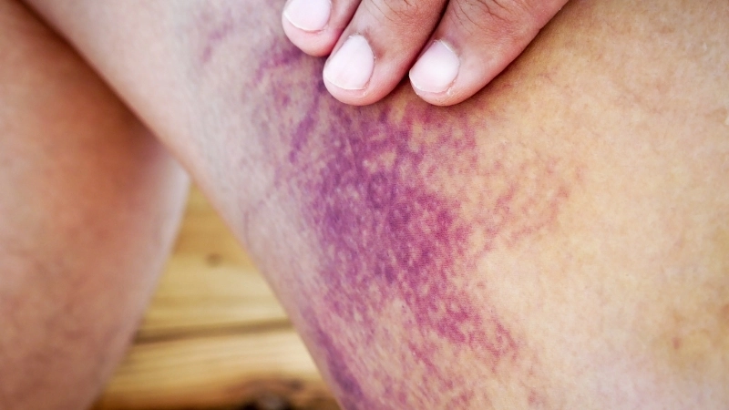 So sánh quá trình đông máu ở người bình thường và người bệnh