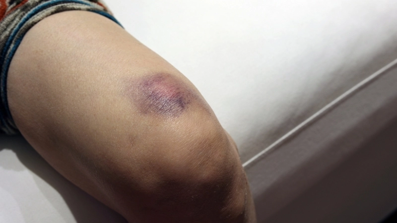 Phương pháp điều trị cho bệnh nhân Hemophilia