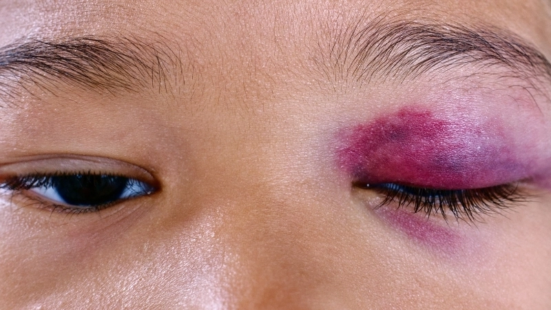 Tầm quan trọng của việc chẩn đoán sớm bệnh máu khó đông