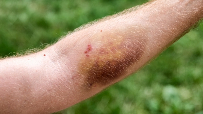 Các triệu chứng bệnh máu khó đông cần lưu ý