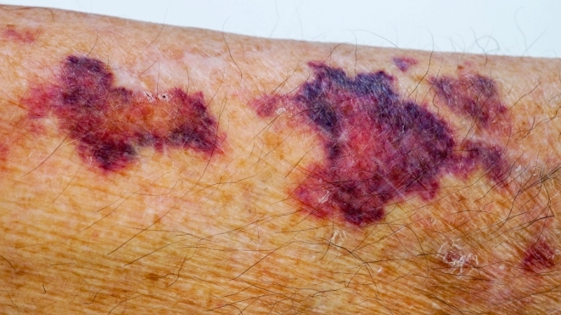 Tiên lượng: Bệnh máu khó đông sống được bao lâu