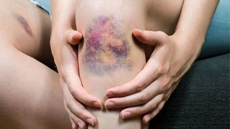 Hình ảnh minh họa quá trình đông máu bị gián đoạn ở bệnh nhân Hemophilia.