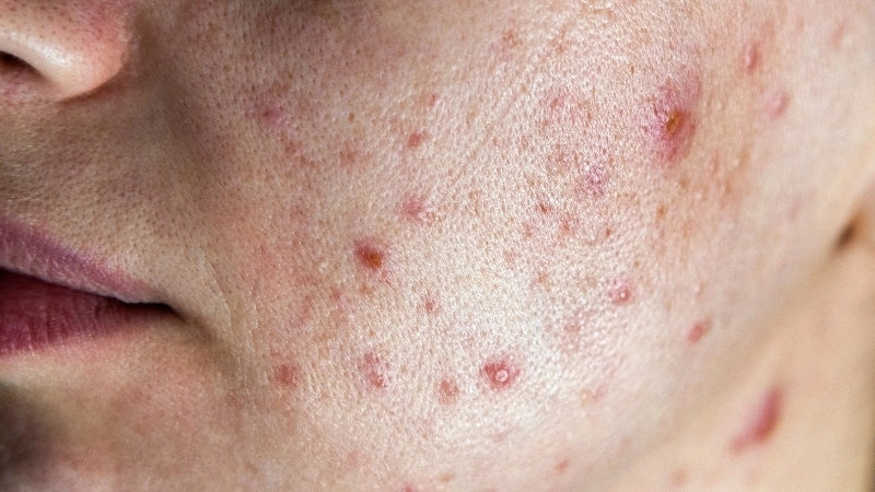 Cách loại bỏ mụn đầu đen ở vùng mũi