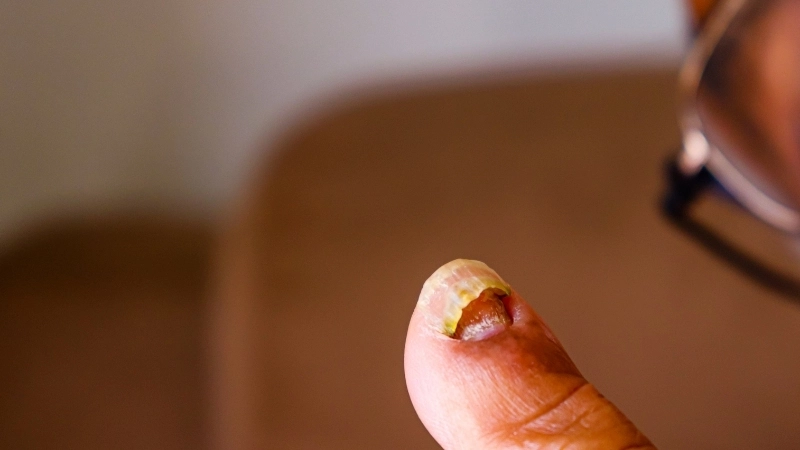 Các đốm da đổi màu trong hình ảnh nấm lang ben