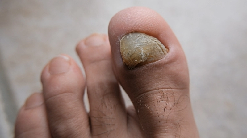 Tình trạng móng bị phá hủy qua hình ảnh nấm móng