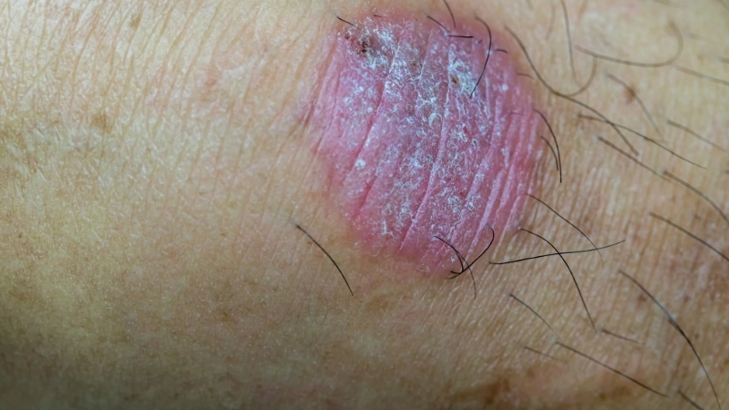 Tổn thương niêm mạc miệng do nấm Candida