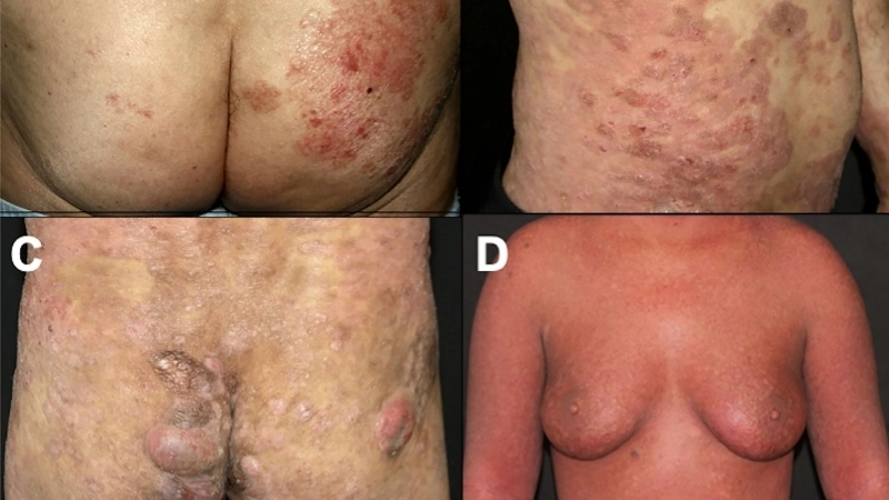 Thông tin về câu hỏi bệnh nấm da có lây không