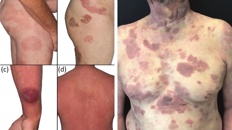 Gợi ý một số loại thuốc trị nấm da hiệu quả