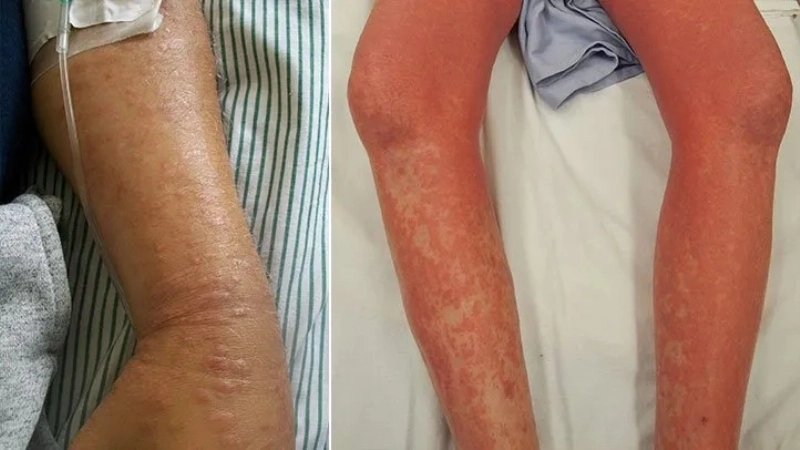 Một loại thuốc bôi nấm được bác sĩ khuyên dùng