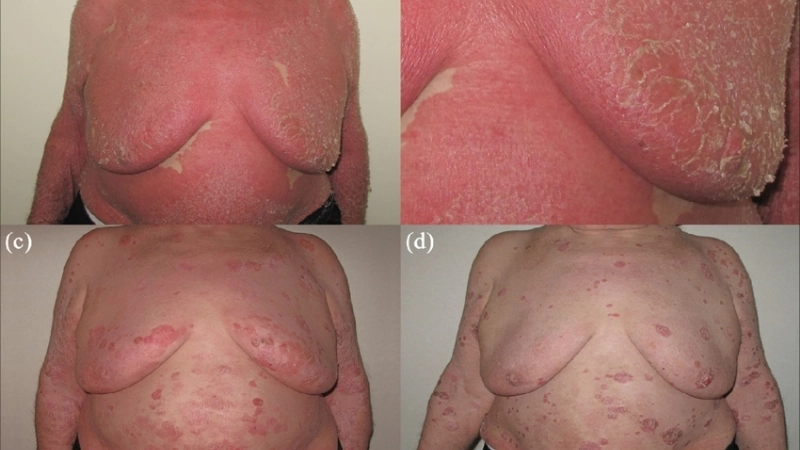 Cách chữa bệnh nấm da tại nhà cần lưu ý