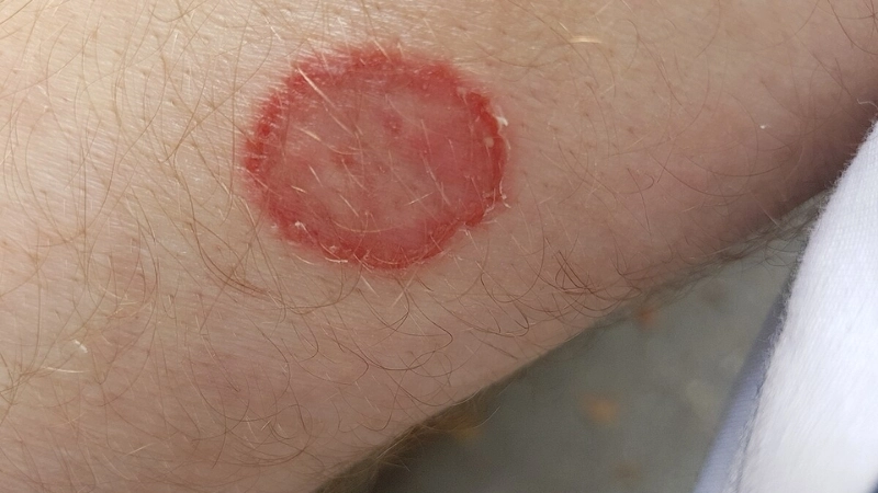 Biểu hiện của hình ảnh bệnh nấm tổ đỉa