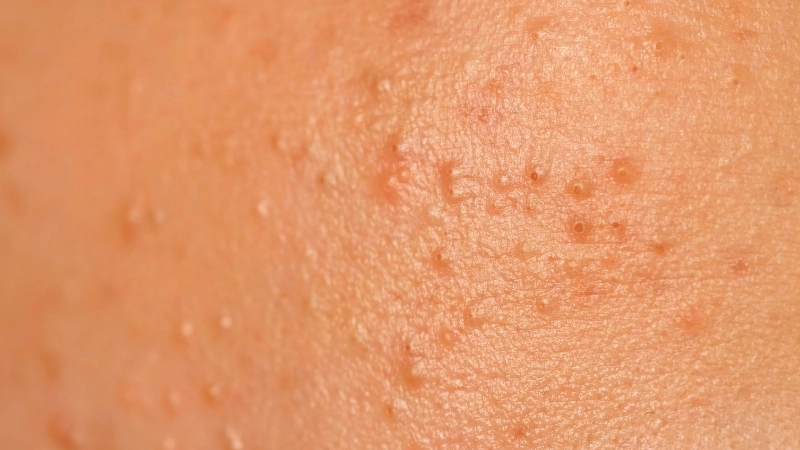 Hình ảnh nấm tóc gây rụng tóc từng mảng