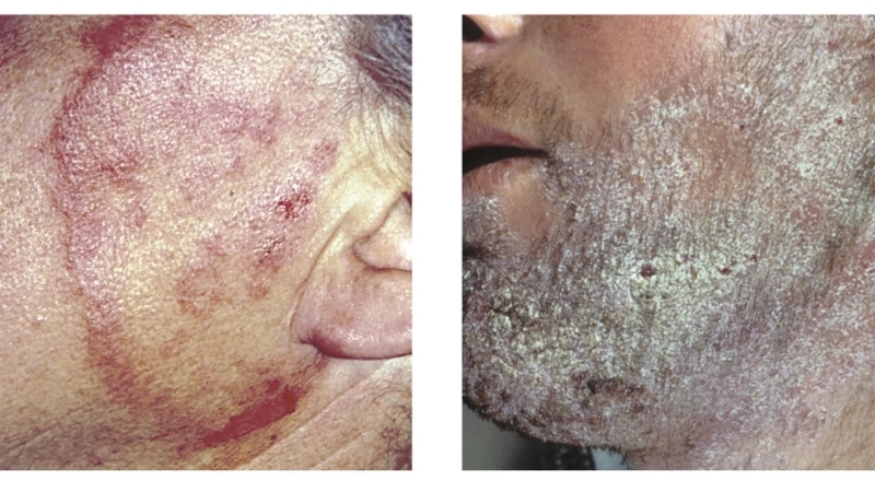 Hình ảnh tổn thương da trước và sau khi dùng thuốc bôi nấm da mặt