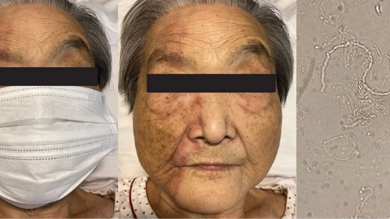 Trả lời câu hỏi nấm da mặt có lây không qua hình minh họa