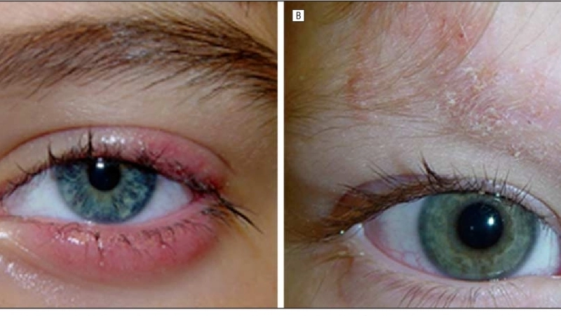 Một số loại thuốc trị nấm da mặt hiệu quả được khuyên dùng